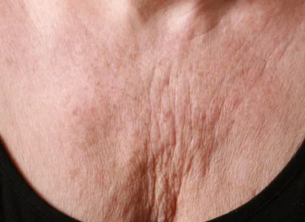 Rughe del décolleté: cause, collagene e fotoinvecchiamento