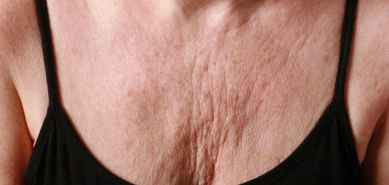 Rughe del décolleté: cause, collagene e fotoinvecchiamento